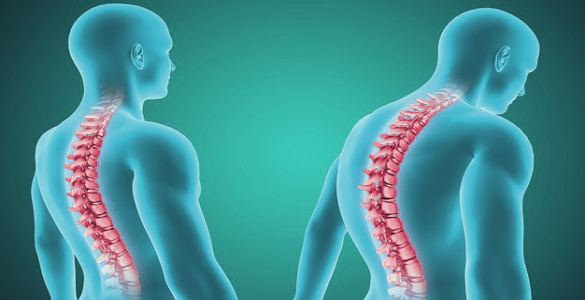 Duas imagens imitando radiografias de uma pessoa com postura normal e outra que sofre de espondilite anquilosante