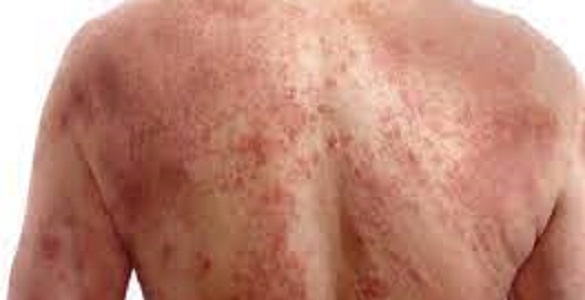 Picture of the back of a person with atopic dermatitis